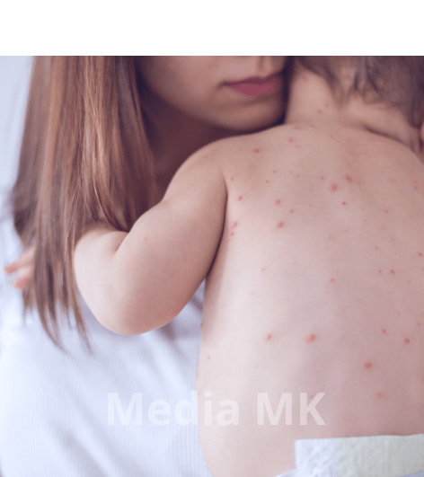 Campak pada Anak dan Orang Dewasa: Gejala yang Sering Diabaikan