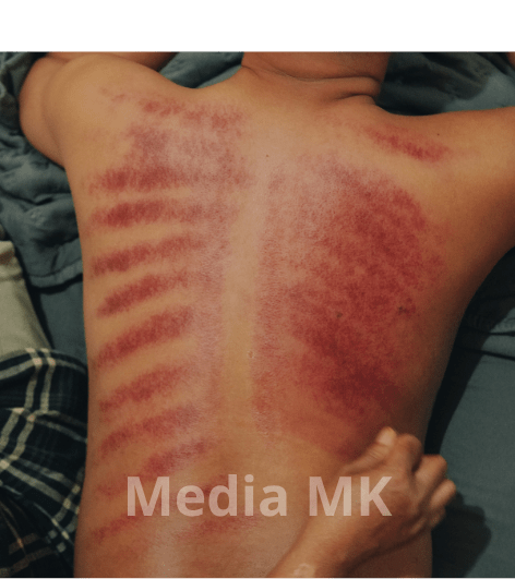 Apakah Kerokan Efektif untuk Mengatasi Masuk Angin?