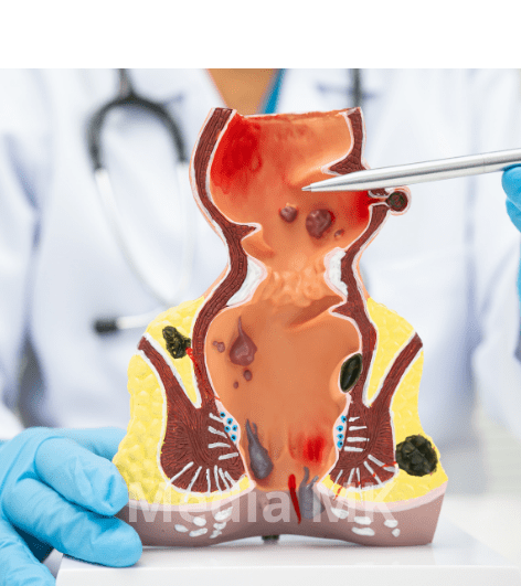 Ambeyen atau Wasir? Ini Penjelasan Lengkap dan Cara Mengobatinya